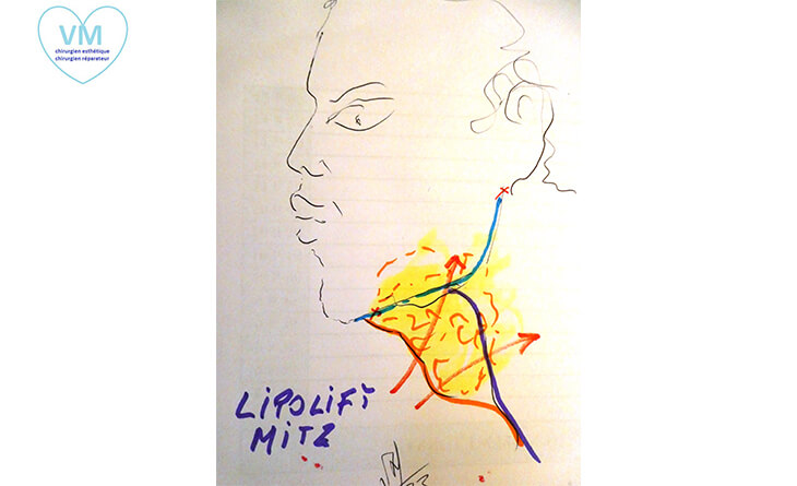 liposiciion du cou ou lipolift -du Docteur Vladimir Mitz -02
